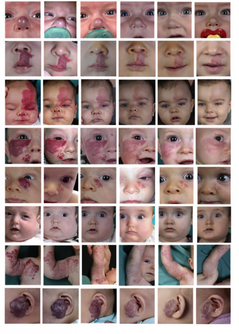 Verlauf der Propranolol-Therapie bei infantilen Hämangiomen (vor Therapiebeginn, 1 Woche, 1 Monat, 3 Monate, 5 Monate und 7 Monate nach Therapiebeginn)