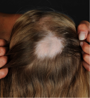 Hautstigma Alopecia Areata Kreisrunder Haarausfall